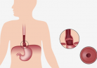 Hiatal Hernia in Dubai