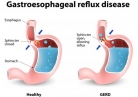 What is Acid Reflux disease?