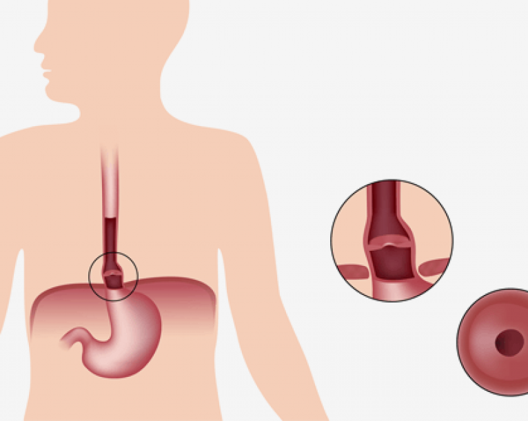 Hiatal Hernia in Dubai